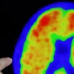 La financiación pública de los nuevos tratamientos para el alzhéimer abre una crisis entre Sanidad y la gran farmacéutica Eli Lilly